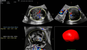 mindray AI ultrasound systems 