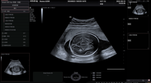 mindray AI ultrasound 