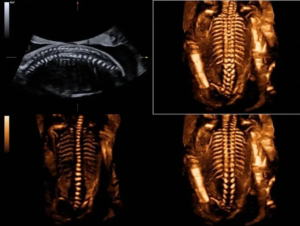 mindray ultrasound ai